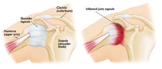 Sameer Singh Frosen Shoulder