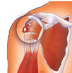 Sameer Singh Impingement With Calcific Tendonitis